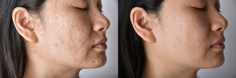 acne scar laser 1760880215