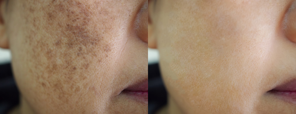 age spots 1386405140