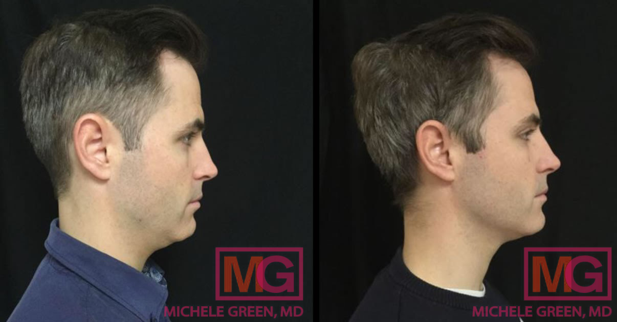 ah 33 kybella before after right MGWatermark