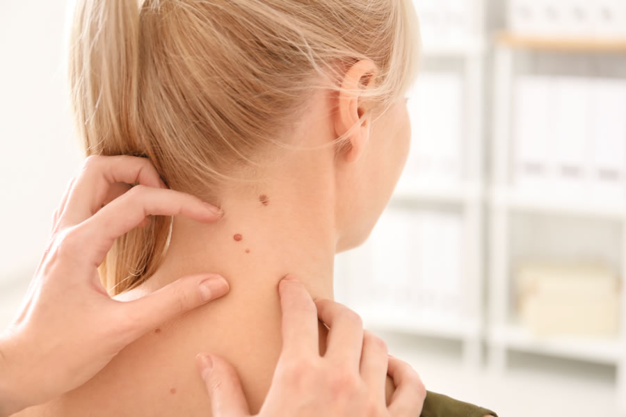 Skin Cancer Vs Mole - Forefront Dermatology