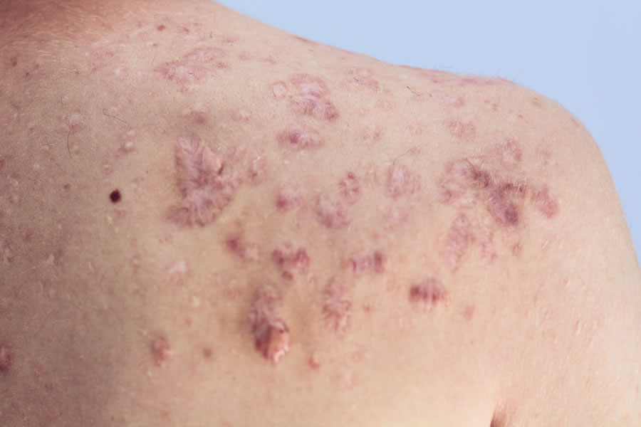 Acne on back discount