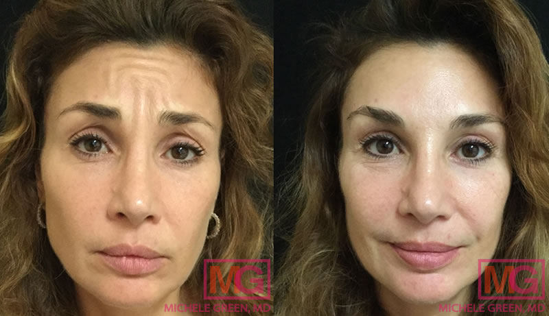 45-54 year old woman treated with Botox