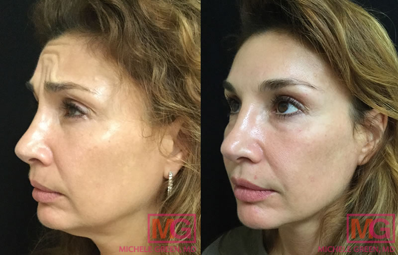 45-54 year old woman treated with Botox