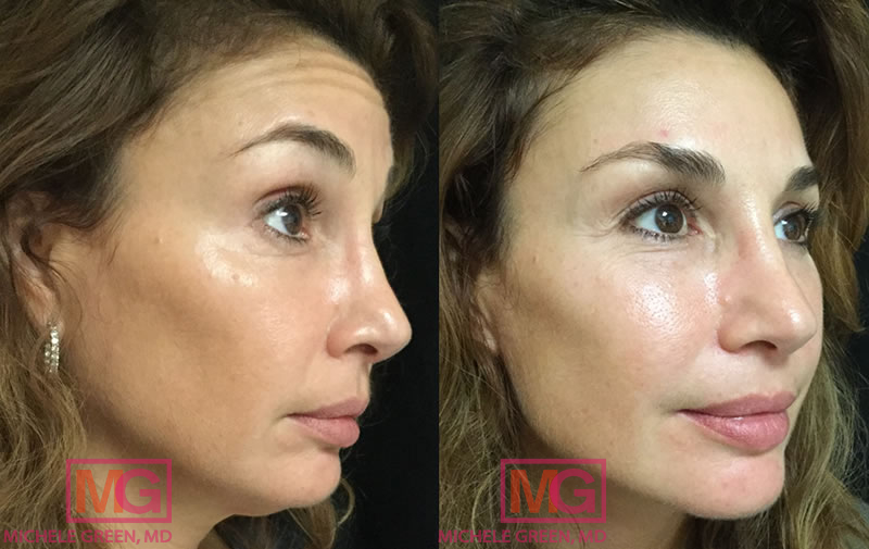 before after botox female rangle b18 a6 MGwatermark
