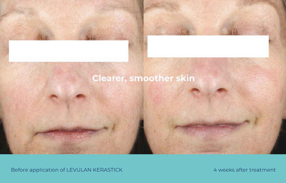 before after levulan