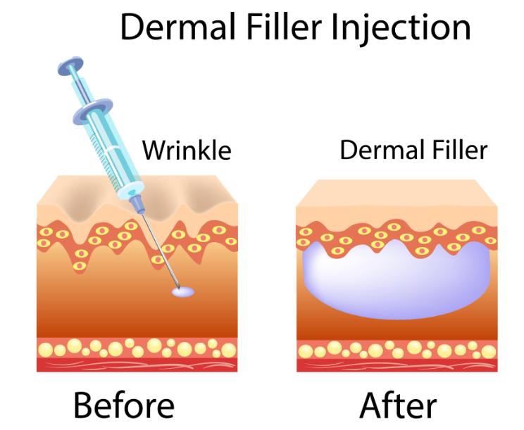 belotero diagram filler