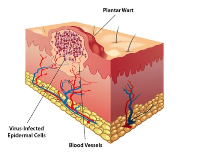 blister wart stock photo