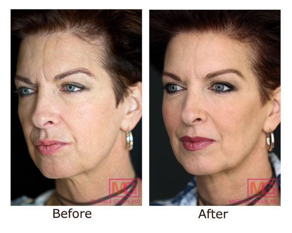 Guide to Botox Injections For Wrinkles, Jaw, Fine Lines & Neck - Botox NYC