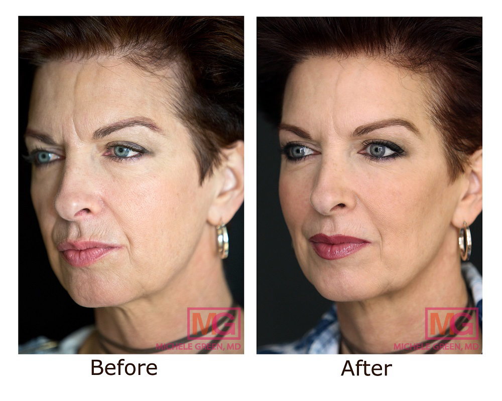 botox voluma before after patient photo dr green MGWatermark