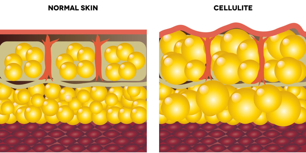 cellulite 132872051