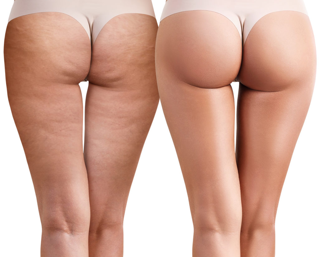 Cellulite Treatment