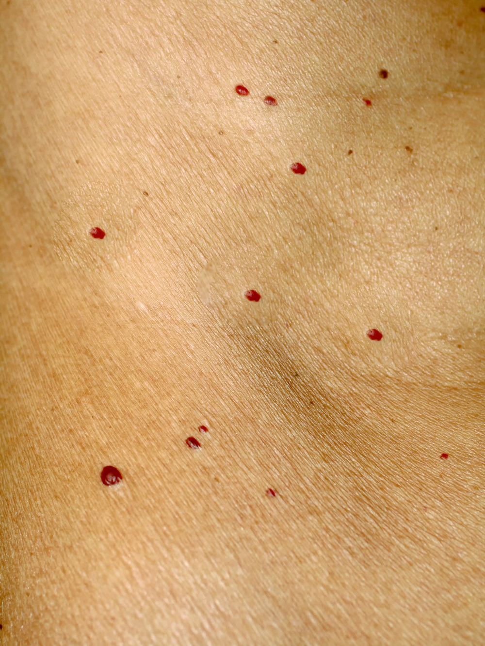 Cherry Angioma Cherry Hemangioma Treatment New York Dr Michele 