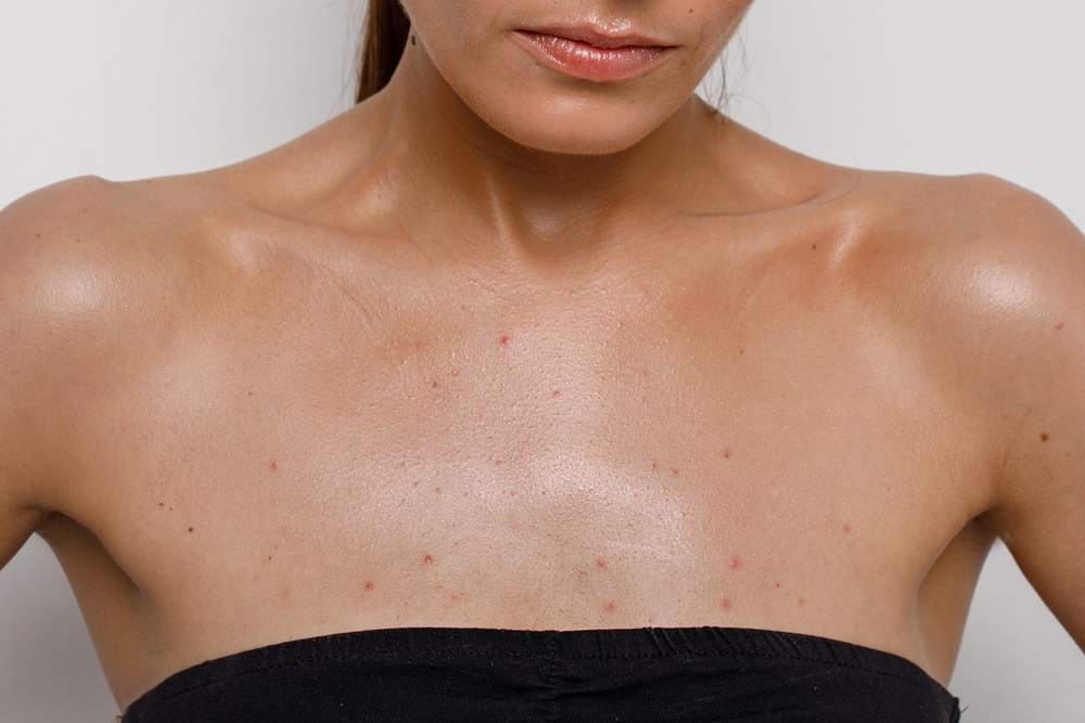 Acne,Close up,On,The,Female,Breast,,Problematic,Teenage,Skin