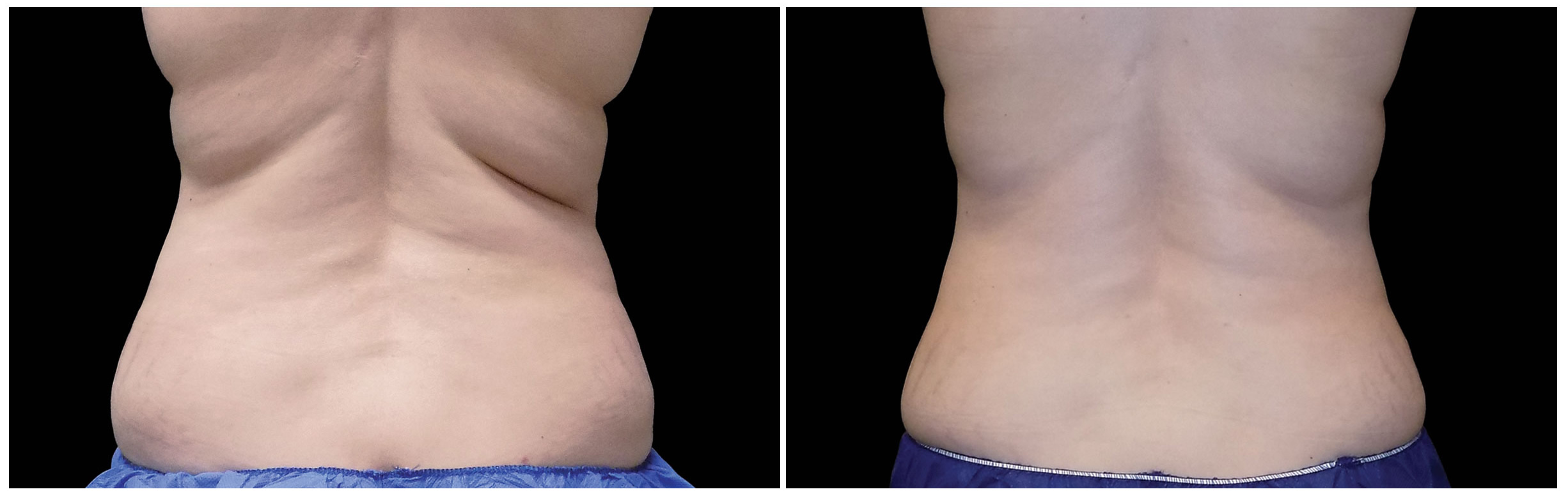 CoolSculpting Review: Bra Fat 