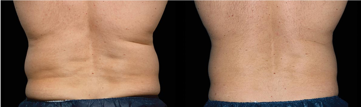 coolsculpting 13W before after