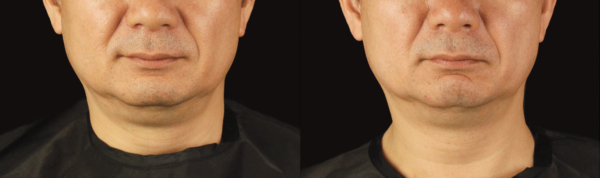 coolsculpting 13W chin before after