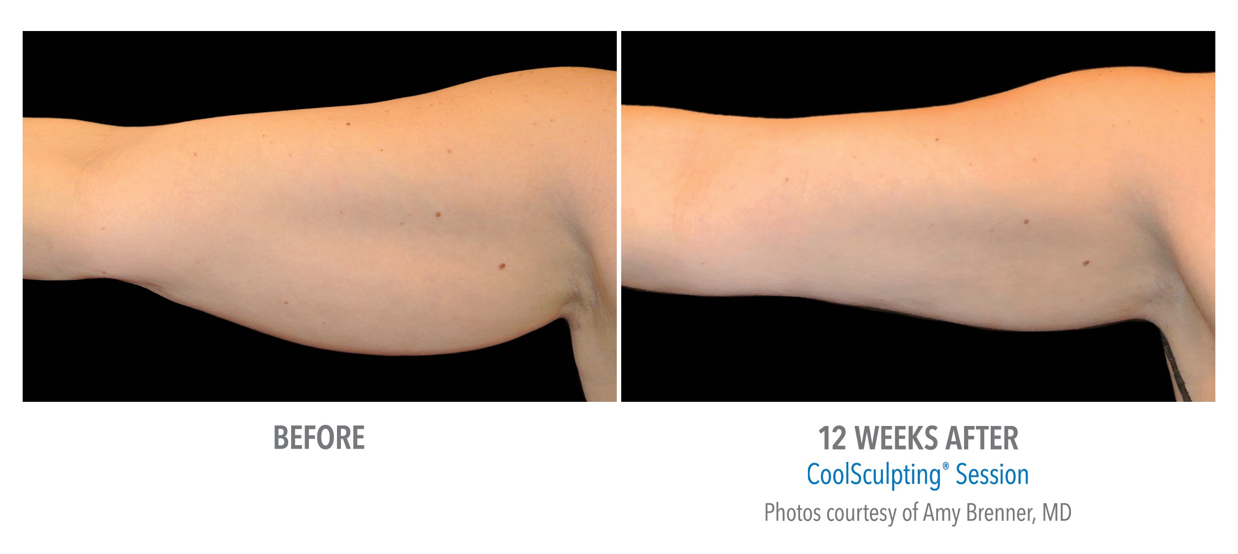 coolsculpting arms 12 weeks