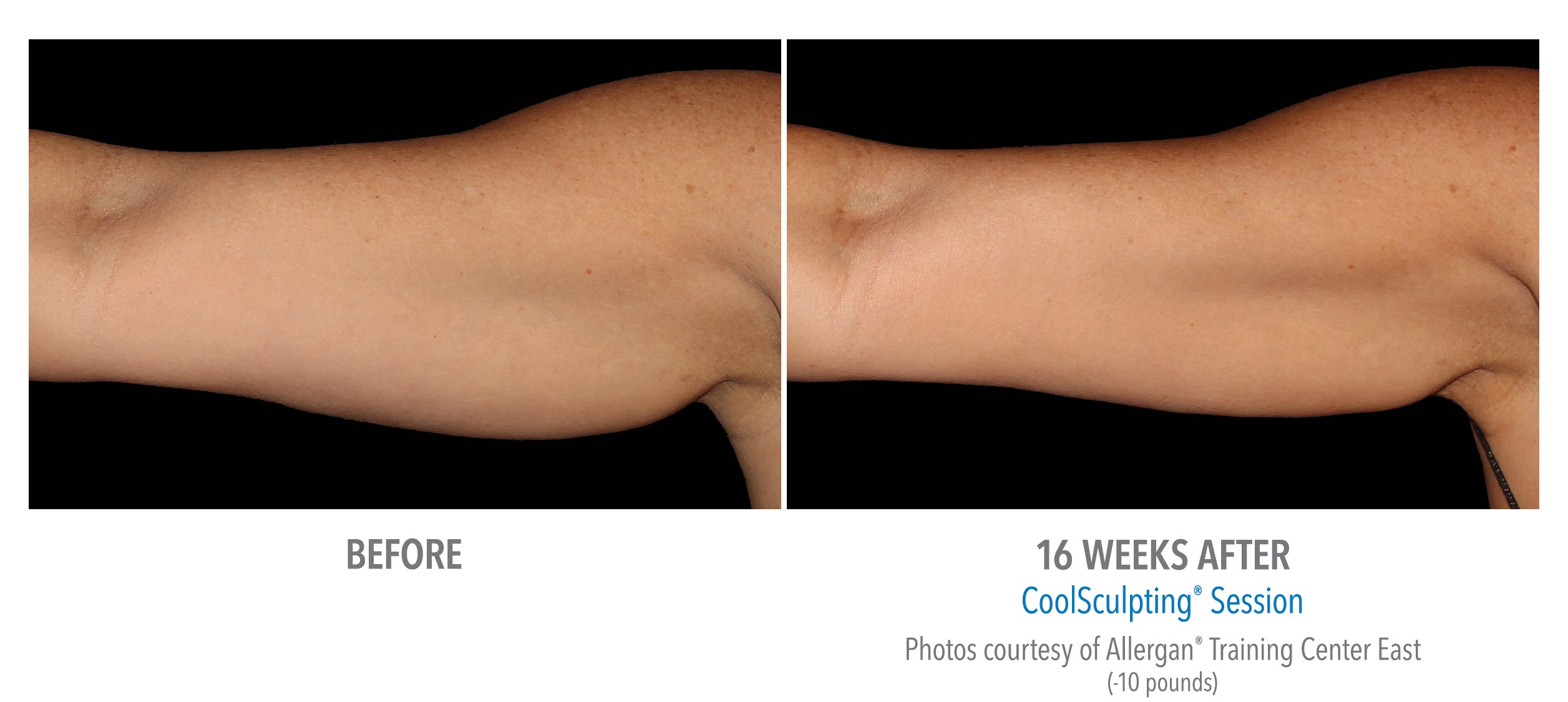 coolsculpting arms 16 weeks