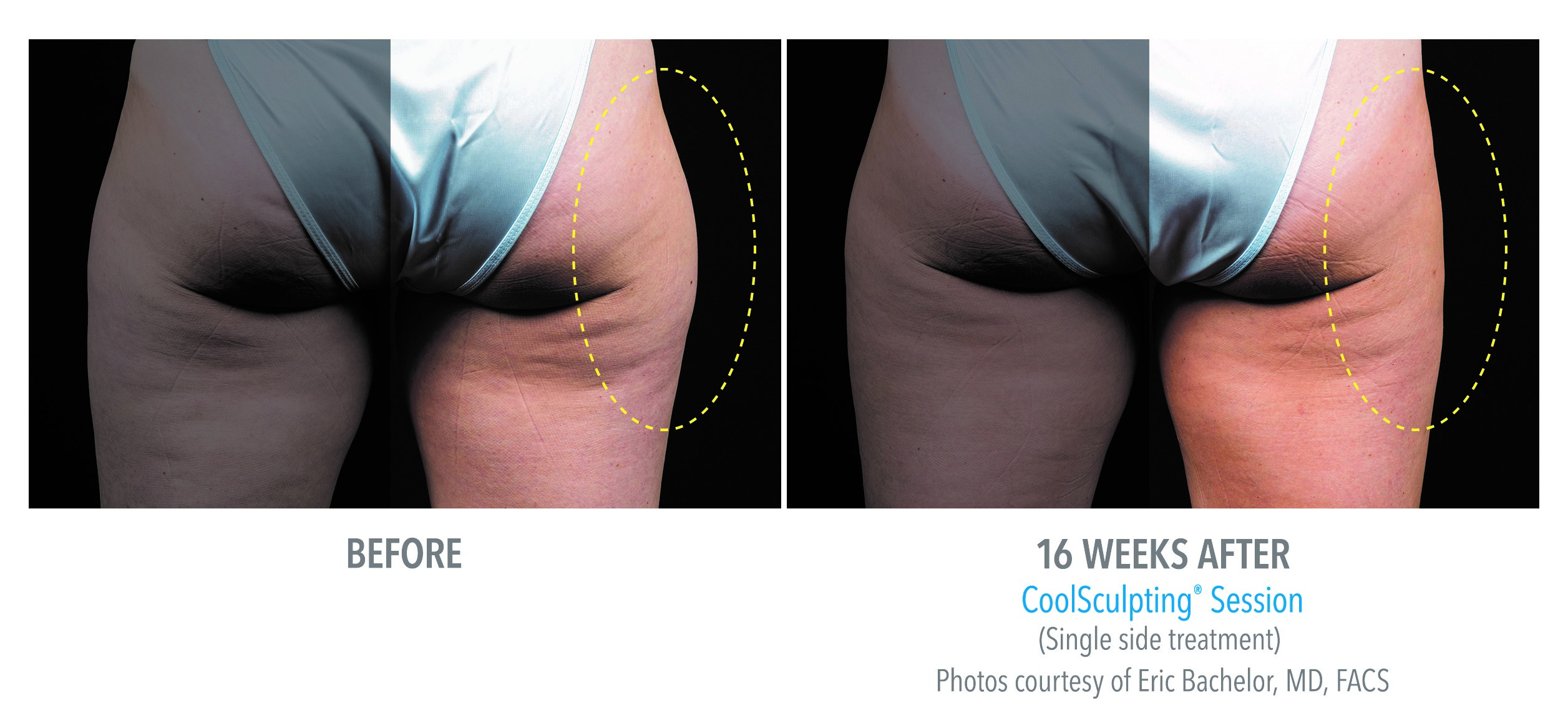 coolsculpting thigh allergan 2