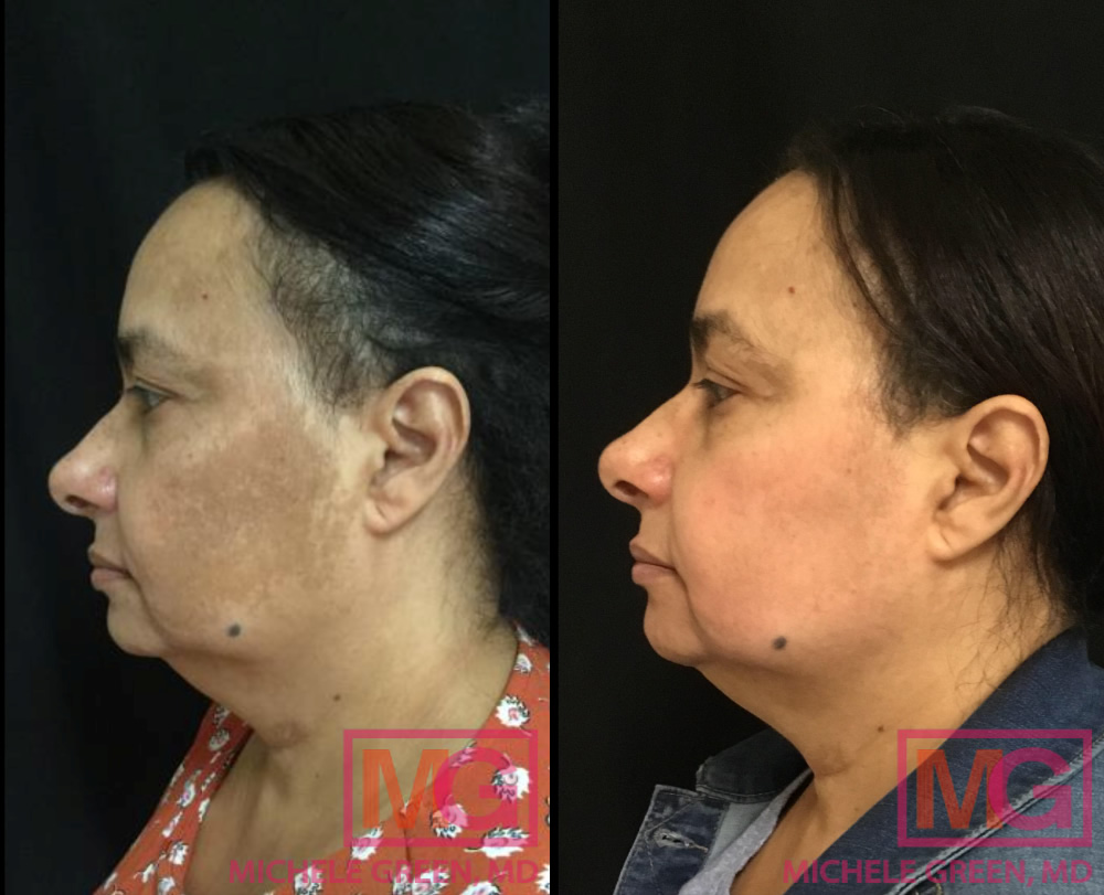 Female - 60's: Before and after Chemical Peels (2 treatments)