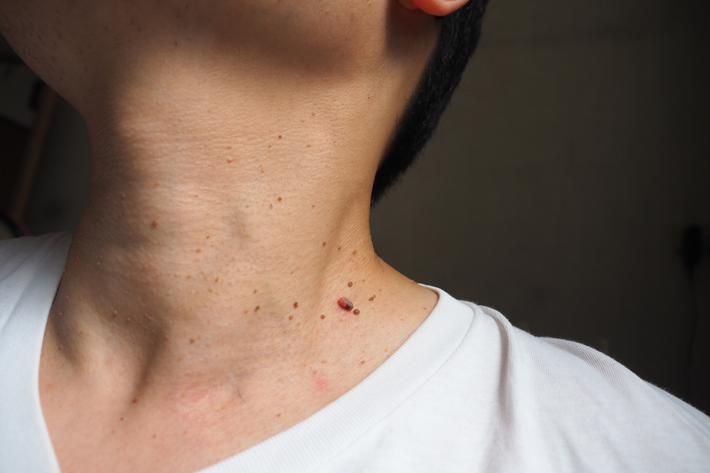 Many,Skin,Tags,Or,Acrochordon,On,The,Neck,Of,An