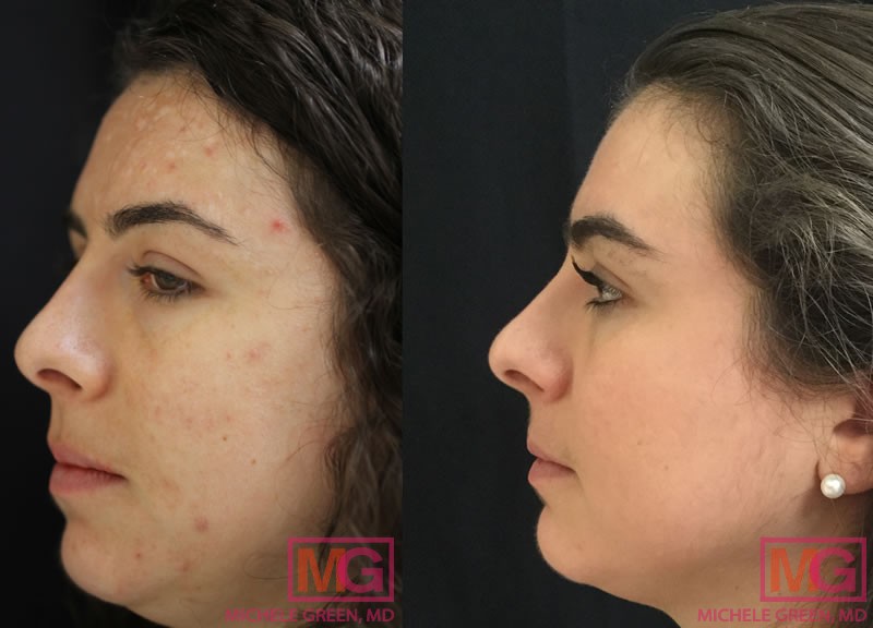 30 year old, 8 Months before and after Acne treatment