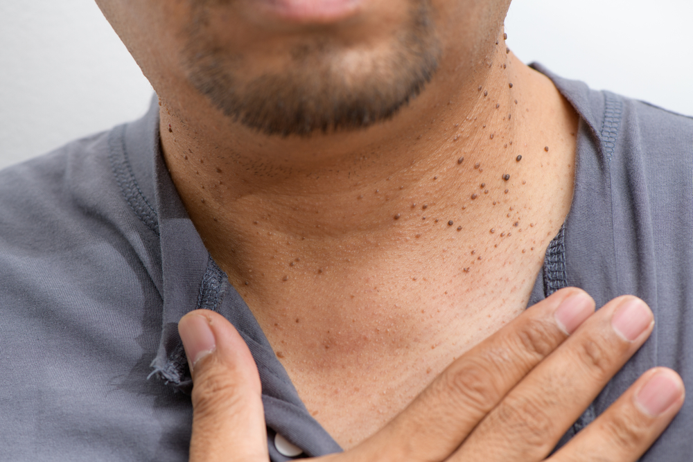 Closed,Up,The,Skin,Tags,Or,Acrochordon,On,Neck,Man
