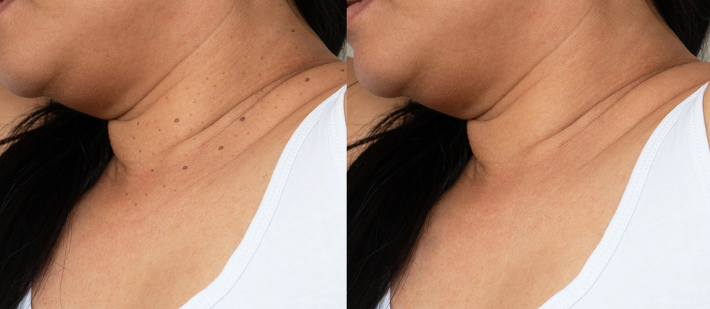 Imperfect,Skin,Texture,Retouched,,Skin,Tags,Removal,Before,And,After