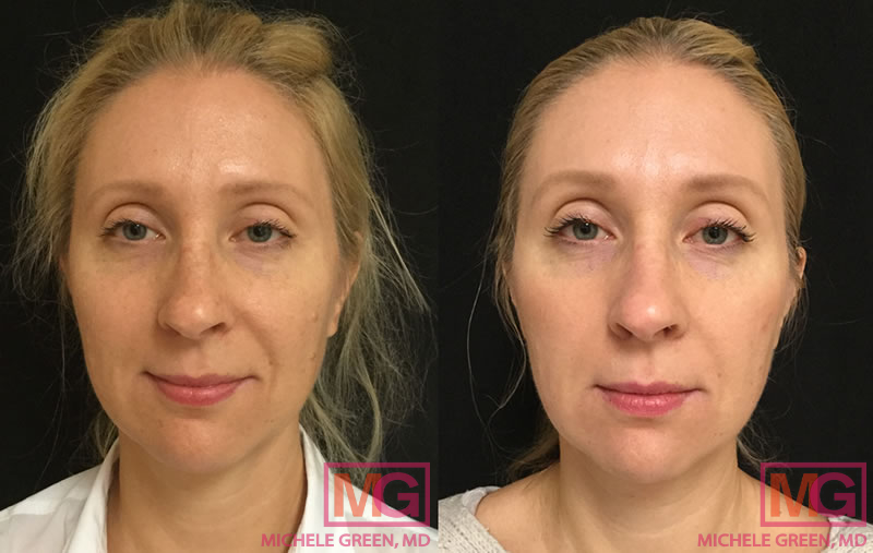 39 Year old female – mole removal