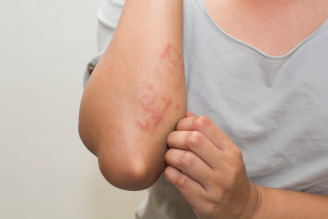 Eczema - Atopic Dermatitis Treatment, Eczema, Skin Inflamation NYC