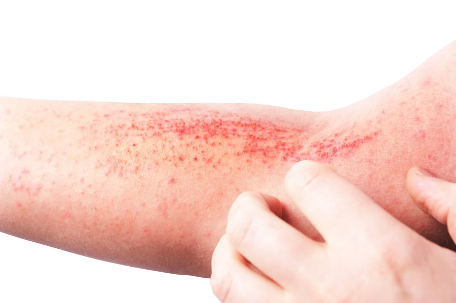 eczema atopic dermatitis 750310090