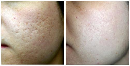 eMatrix for Acne Scars, Before and After Photos - eMatrix NYC