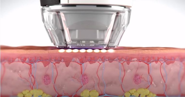 eMatrix™ NYC, eMatrix Sublative Rejuvenation Treatments