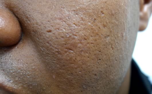 example-of-icepick-acne-scars.jpg