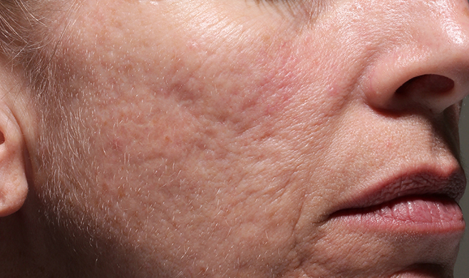 example of rolling acne scars