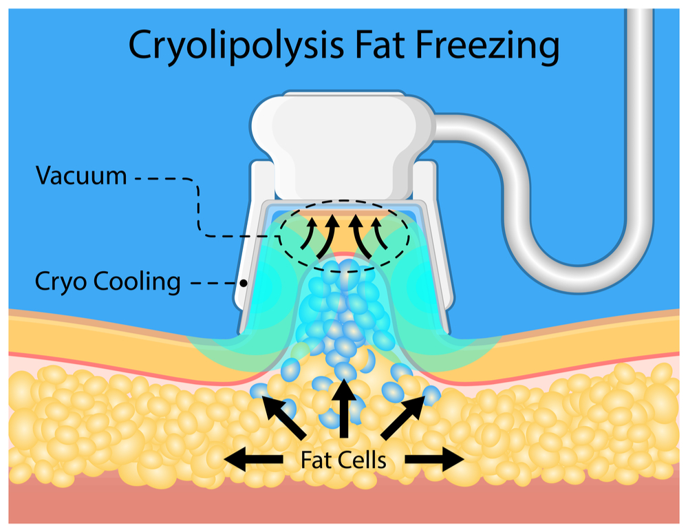 fat freezing diagram