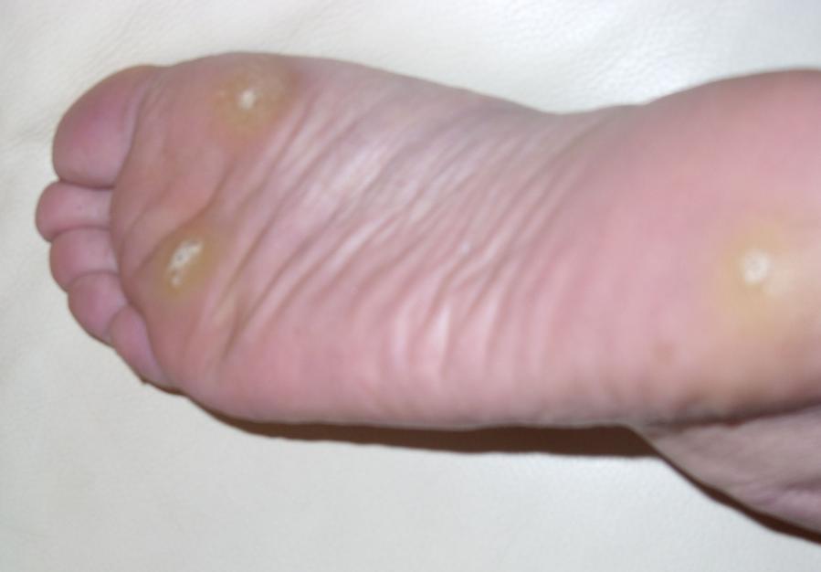 foot warts
