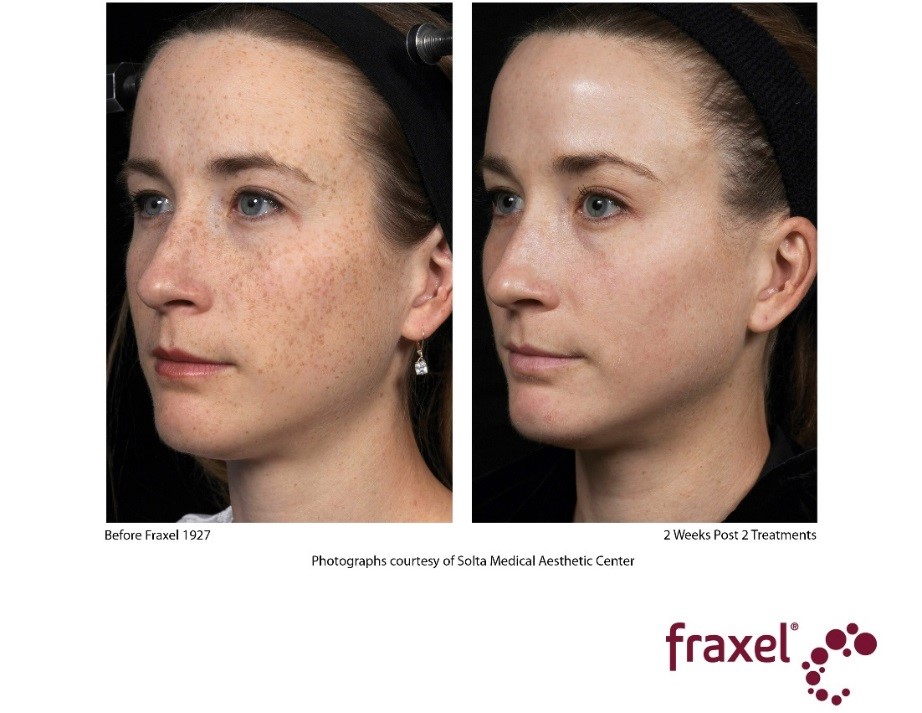 How Does Fraxel Laser Treatment Work, Fraxel Laser Procedures NYC