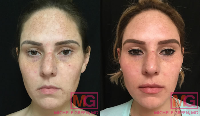 28 year old treated with Fraxel & Juvederm 