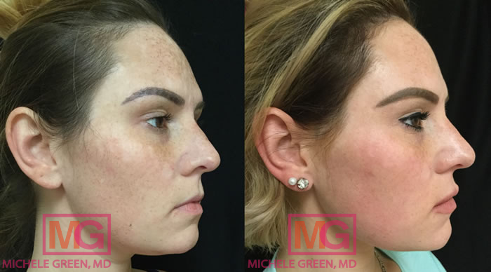 28 year old treated with Fraxel & Juvederm 