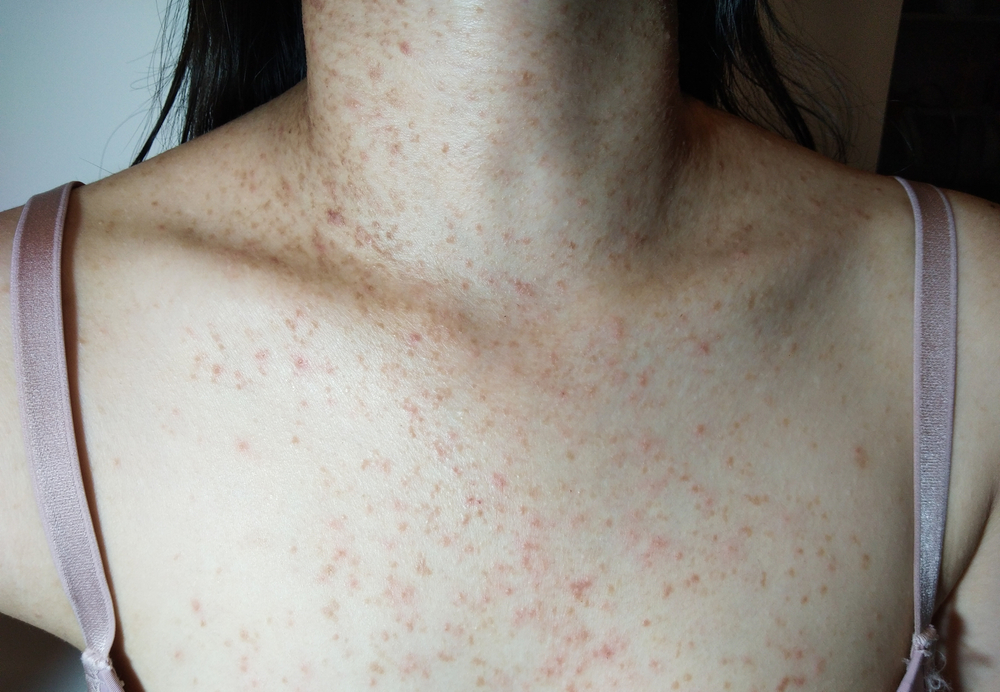Women,With,Acne,,Skin,Disease,,Folliculitis,Inflammation,,Fungal,Infection