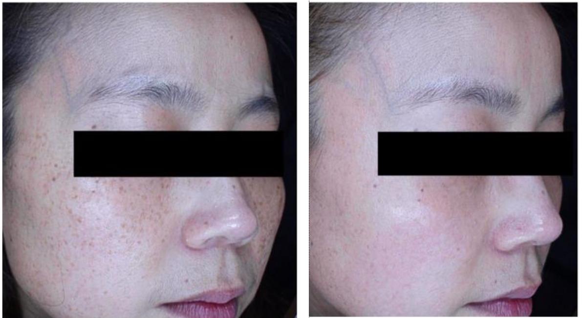 helios freckle removal