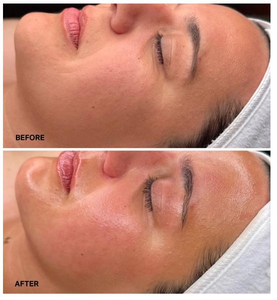 hydrafacial