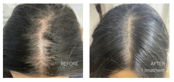 hydrafacial keravive before after
