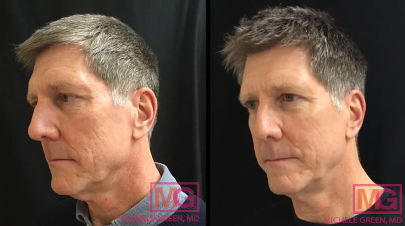 Microneedling Before & After Photos - Dr. Michele Green M.D.