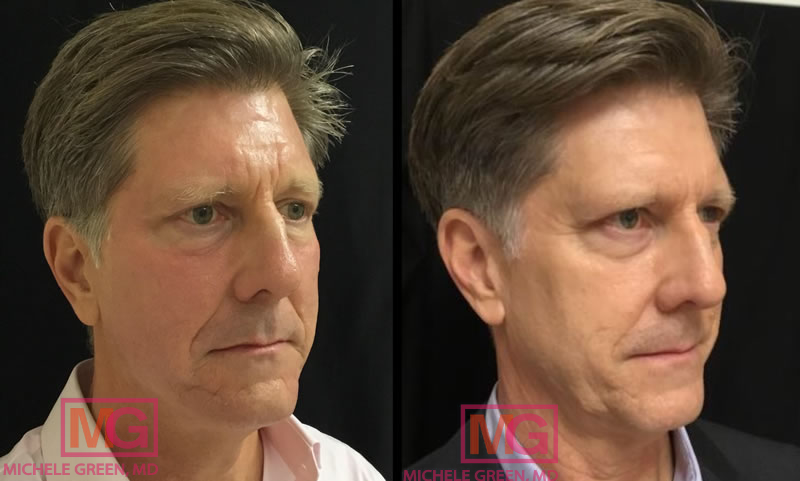 55-64 year old man, Aquagold w/ Botox – 1 month post treatment
