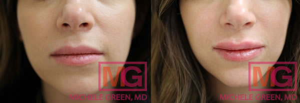 juvederm before after 4577 MGwatermark