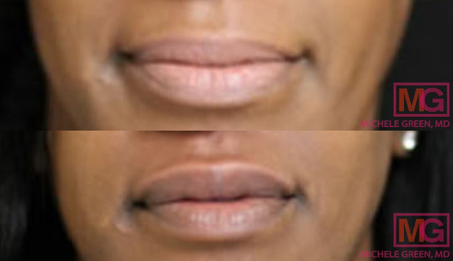 juvederm ultra female lips SQ