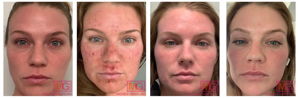 laser acne scars 1