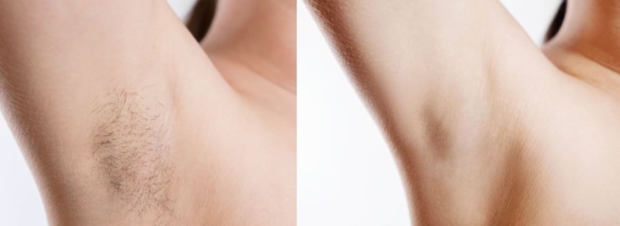 laser hair removal nyc best